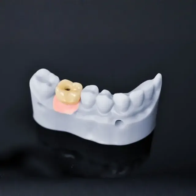The Root Canal Treatment Process