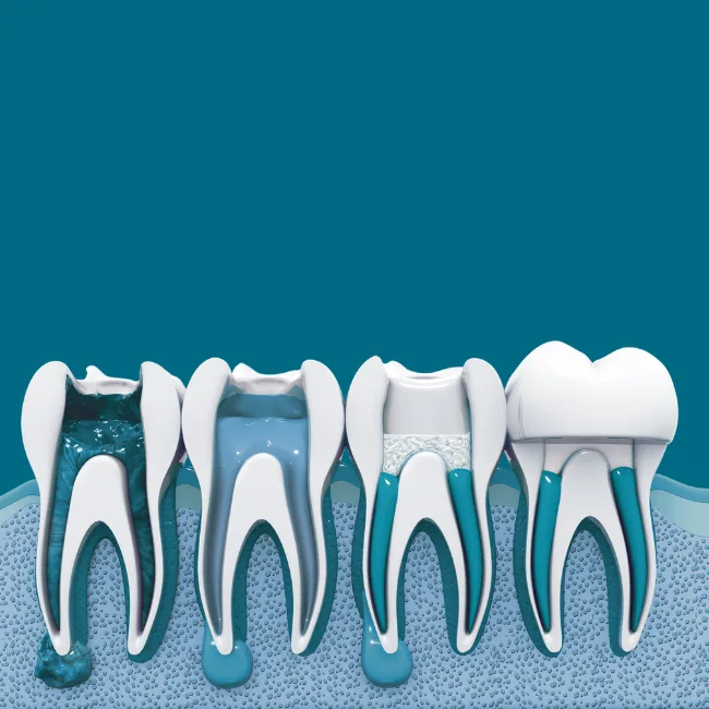 Root Canal Therapy