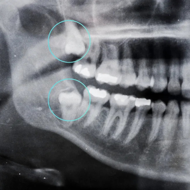 Wisdom Tooth Removal