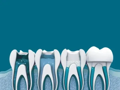 Root Canal Therapy