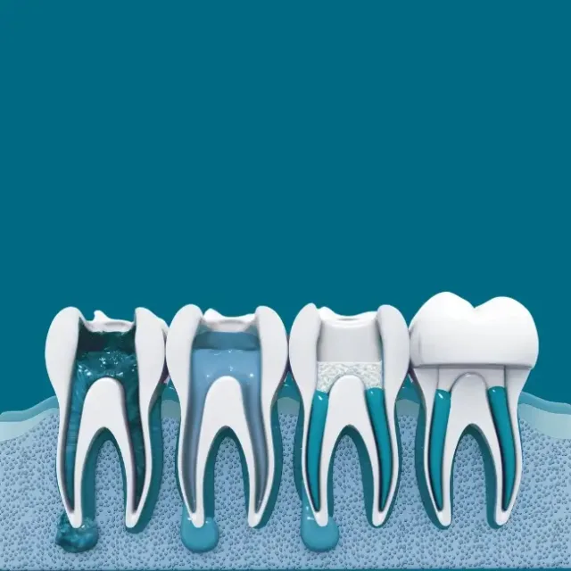 Root Canal Therapy