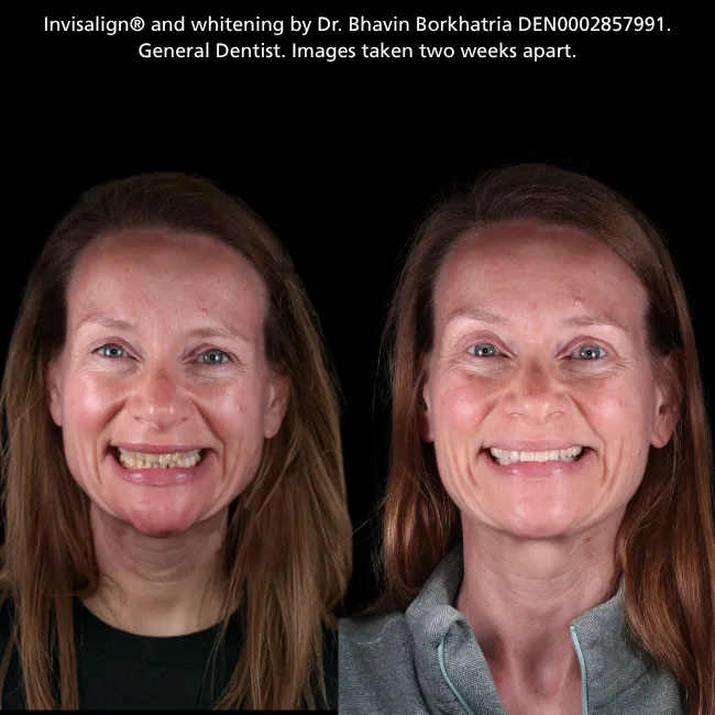 Smile Makeovers