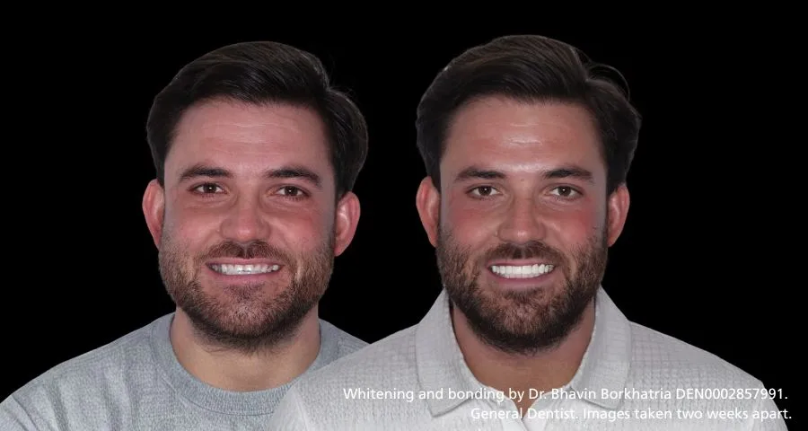 Smile makeover (Invisalign and bonding)