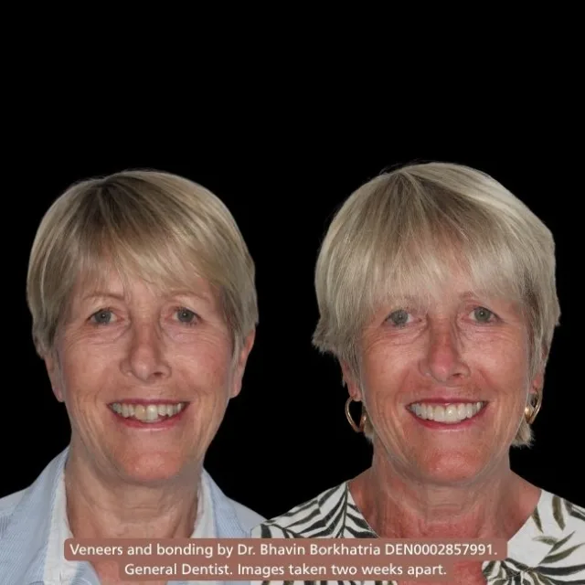 Veneers and bonding