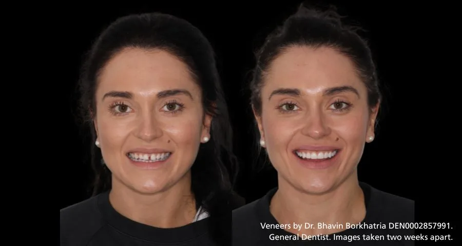 Veneers