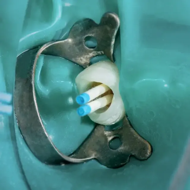 Who Might Need Root Canal Therapy