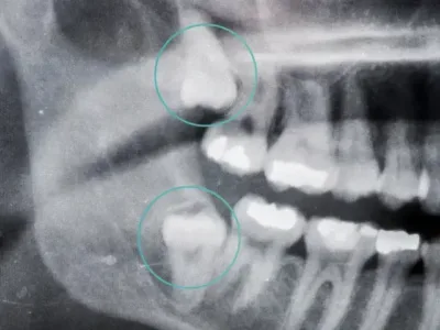 Wisdom Tooth Removal