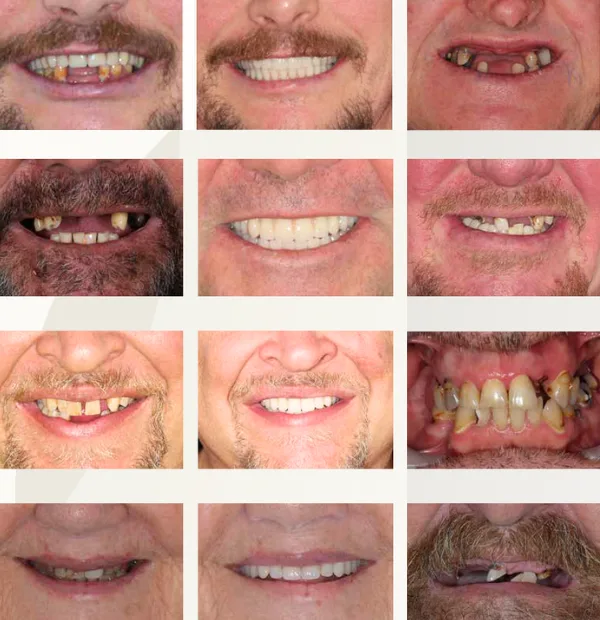 Why Consider Full Mouth Dental Implants