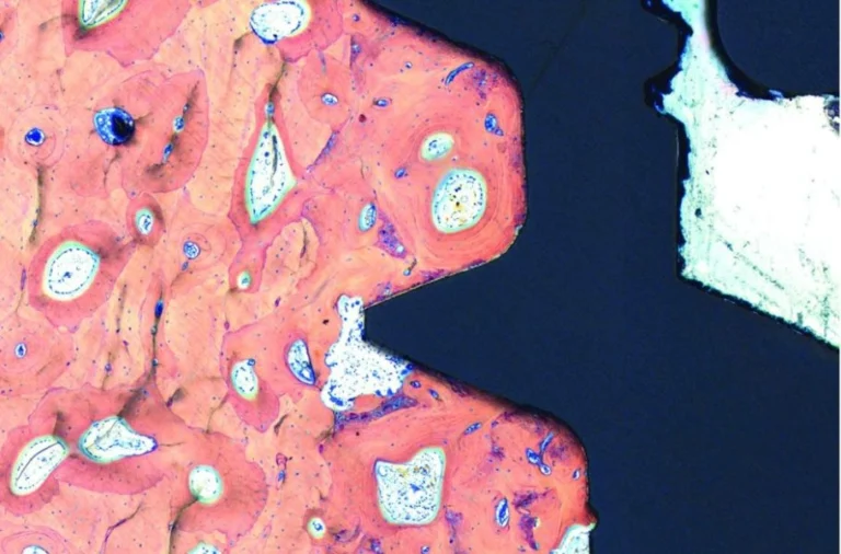 osseointegration