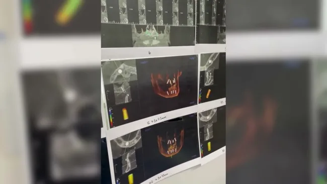 All-on-4® Dental Implants